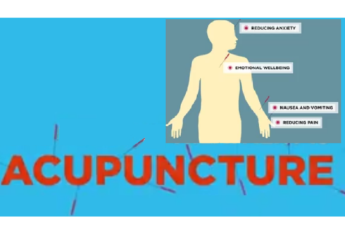 Sloan Kettering Memorial Acupuncture for Chemotherapy